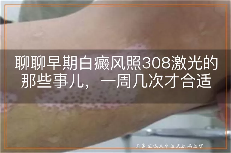 聊聊早期白癜风照308激光的那些事儿，一周几次才合适？