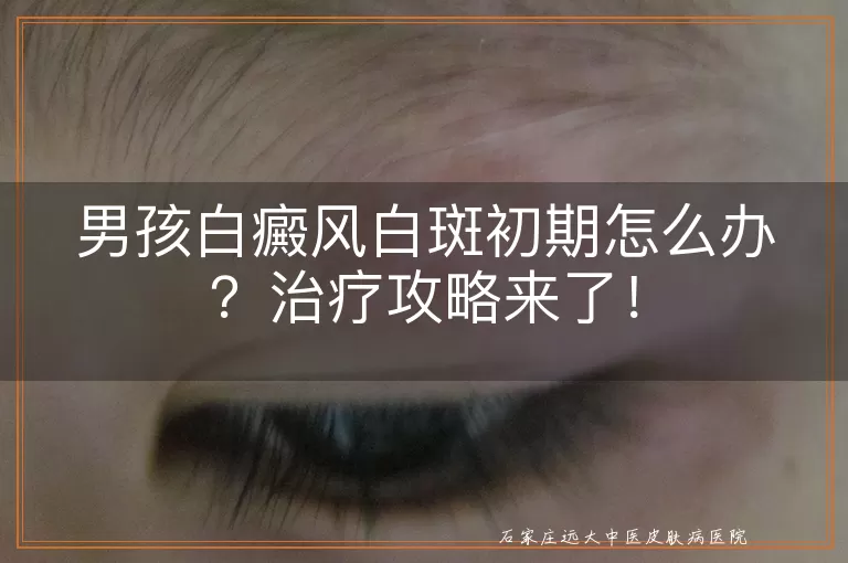男孩白癜风白斑初期怎么办？治疗攻略来了！