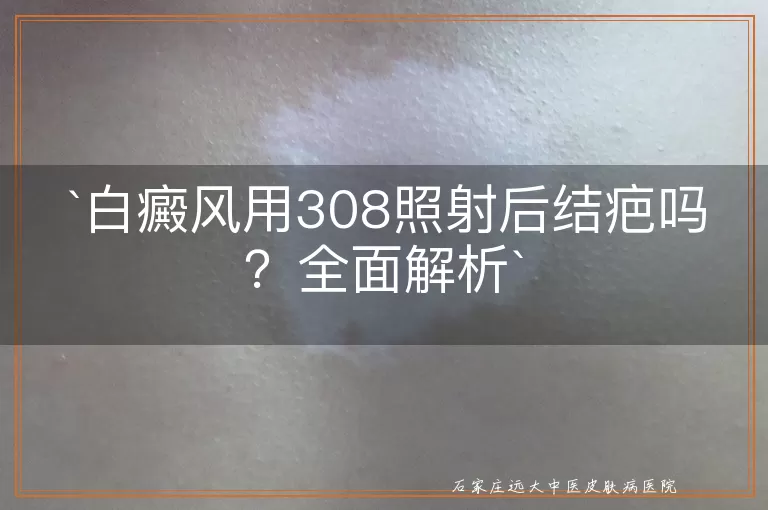 白癜风用308照射后结疤吗？全面解析