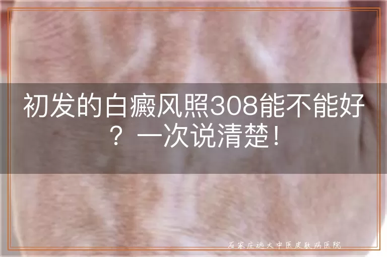 初发的白癜风照308能不能好？一次说清楚！
