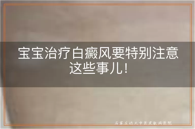 宝宝治疗白癜风要特别注意这些事儿！