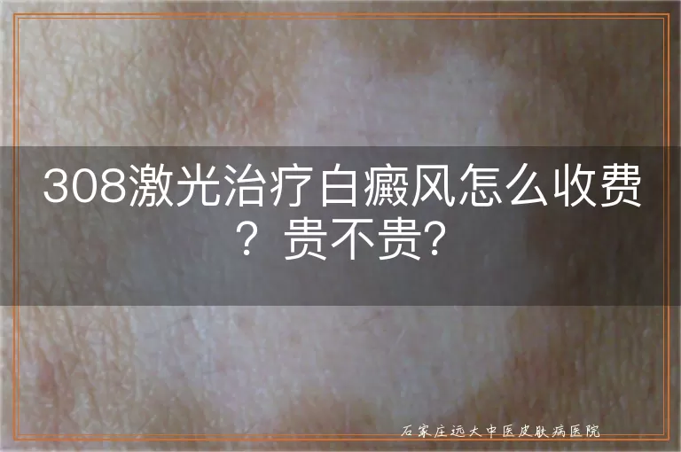 308激光治疗白癜风怎么收费？贵不贵？