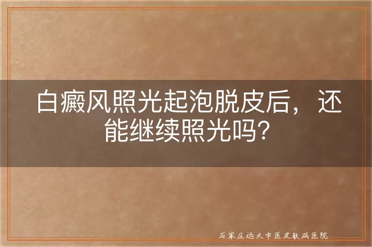 白癜风照光起泡脱皮后，还能继续照光吗？