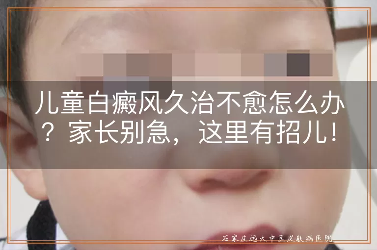 儿童白癜风久治不愈怎么办？家长别急，这里有招儿！