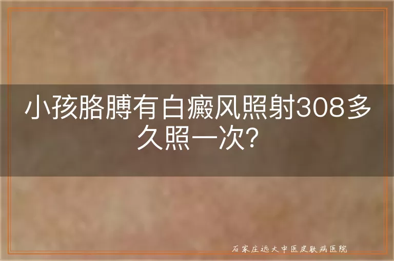 小孩胳膊有白癜风照射308多久照一次？