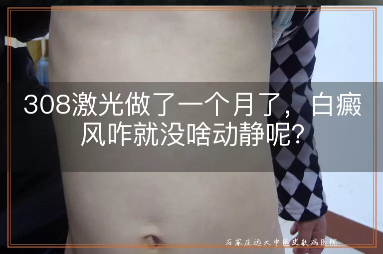 308激光做了一个月了，白癜风咋就没啥动静呢？