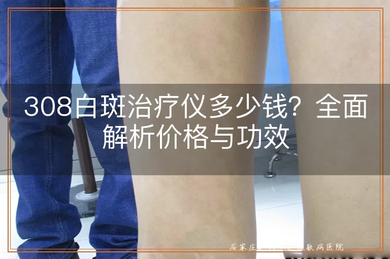 308白斑治疗仪多少钱？全面解析价格与功效
