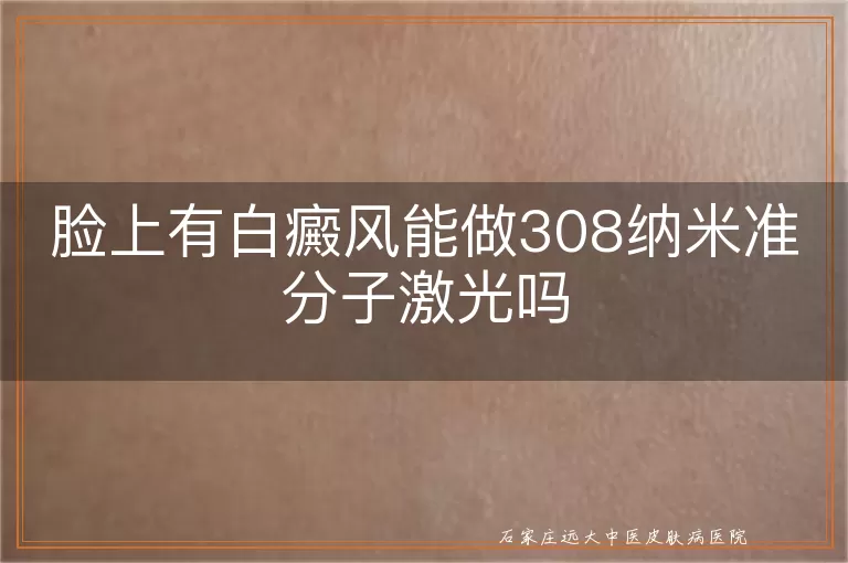 脸上有白癜风能做308纳米准分子激光吗