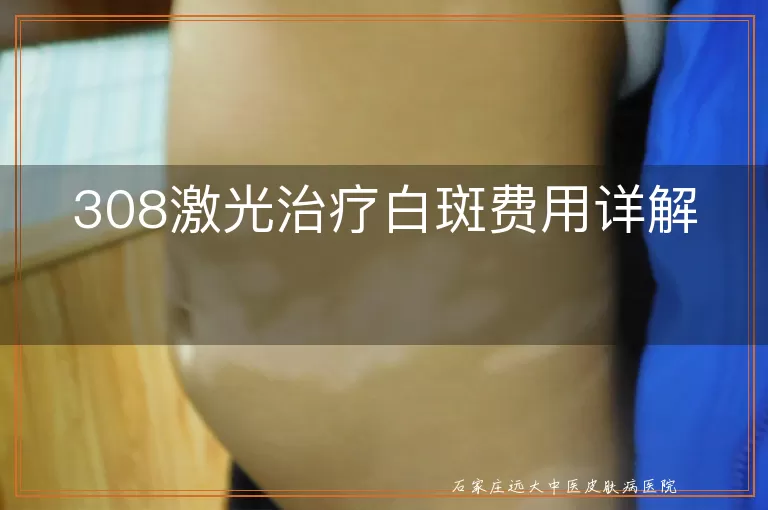 308激光治疗白斑费用详解