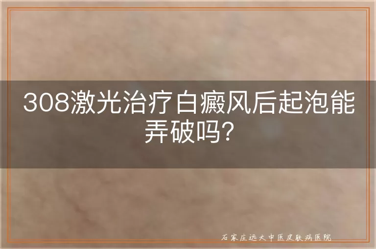 308激光治疗白癜风后起泡能弄破吗？