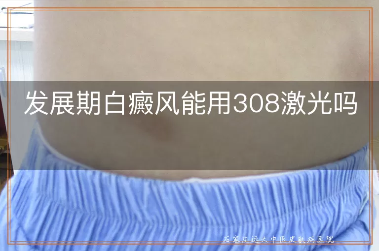 发展期白癜风能用308激光吗
