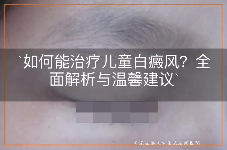 如何能治疗儿童白癜风？全面解析与温馨建议