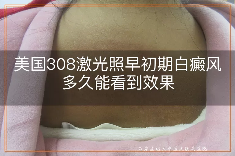 美国308激光照早初期白癜风多久能看到效果