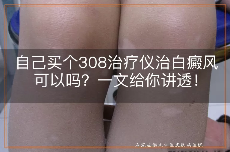 自己买个308治疗仪治白癜风可以吗？一文给你讲透！