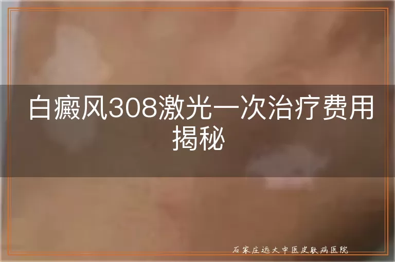 白癜风308激光一次治疗费用揭秘