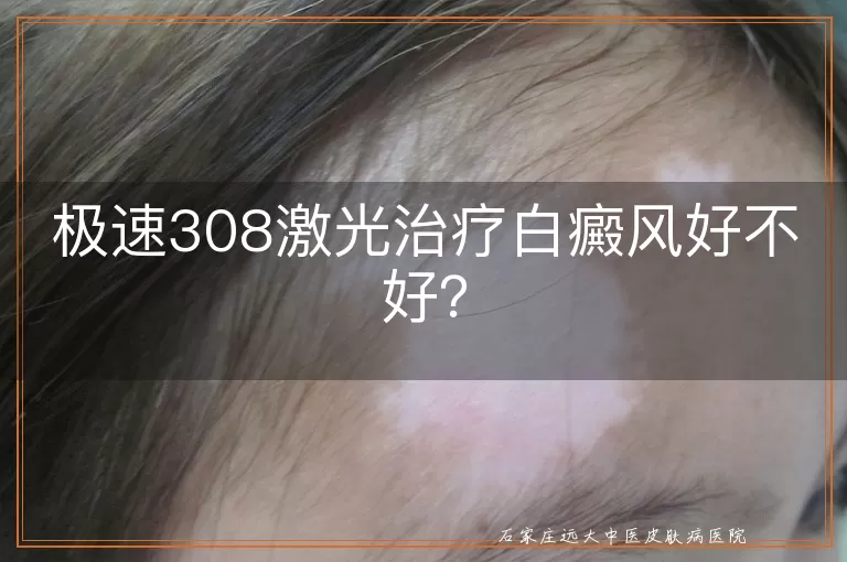 极速308激光治疗白癜风好不好？
