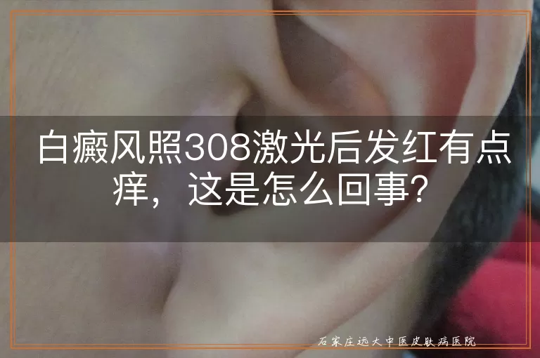 白癜风照308激光后发红有点痒，这是怎么回事？