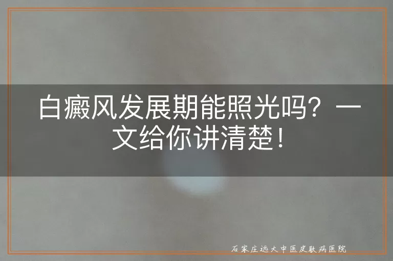 白癜风发展期能照光吗？一文给你讲清楚！