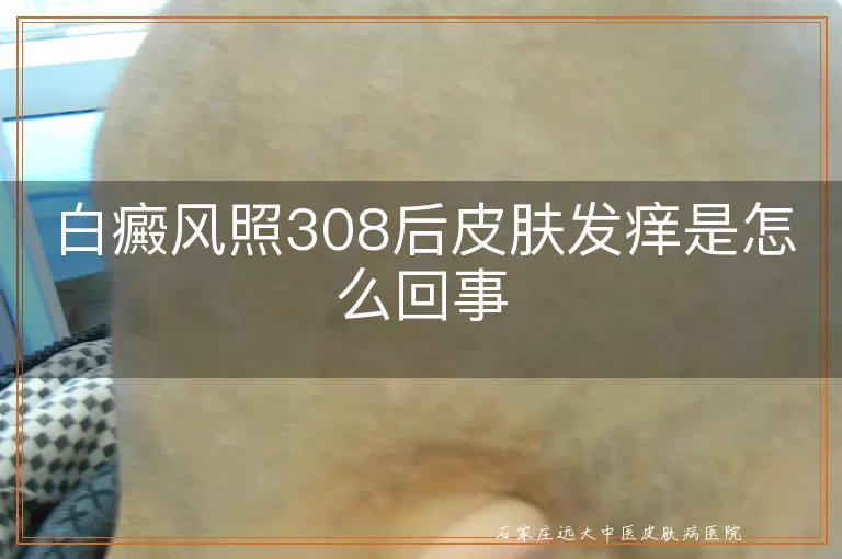 白癜风照308后皮肤发痒是怎么回事