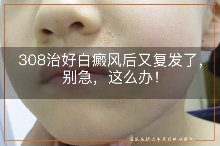 308治好白癜风后又复发了，别急，这么办！