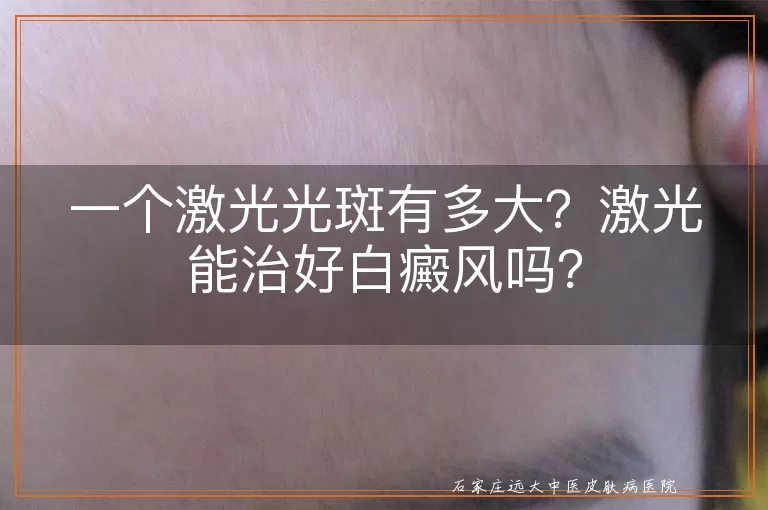 一个激光光斑有多大？激光能治好白癜风吗？