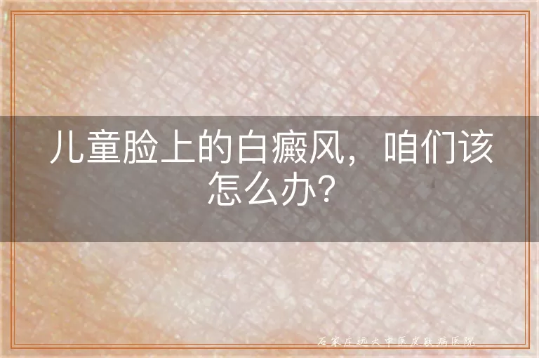 儿童脸上的白癜风，咱们该怎么办？