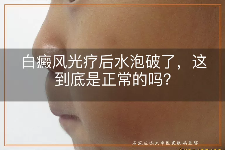 白癜风光疗后水泡破了，这到底是正常的吗？