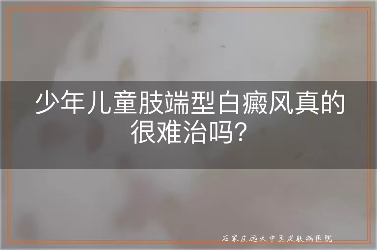 少年儿童肢端型白癜风真的很难治吗？