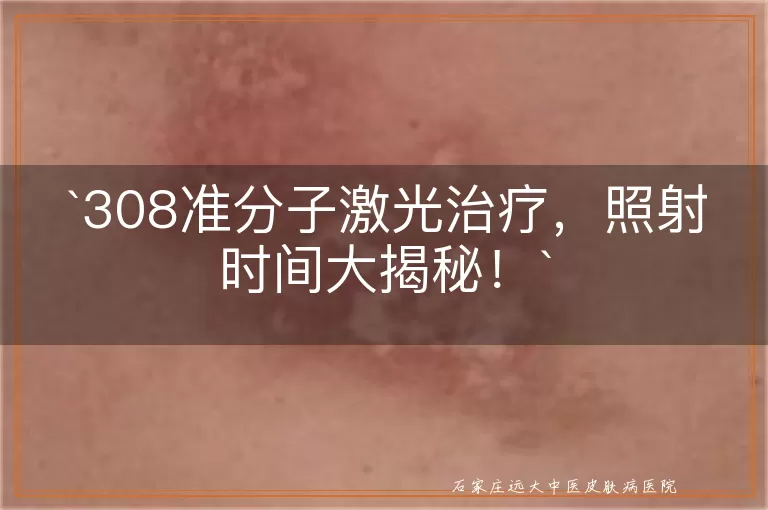 308准分子激光治疗，照射时间大揭秘！