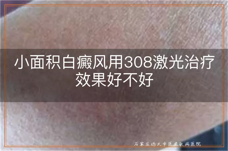 小面积白癜风用308激光治疗效果好不好