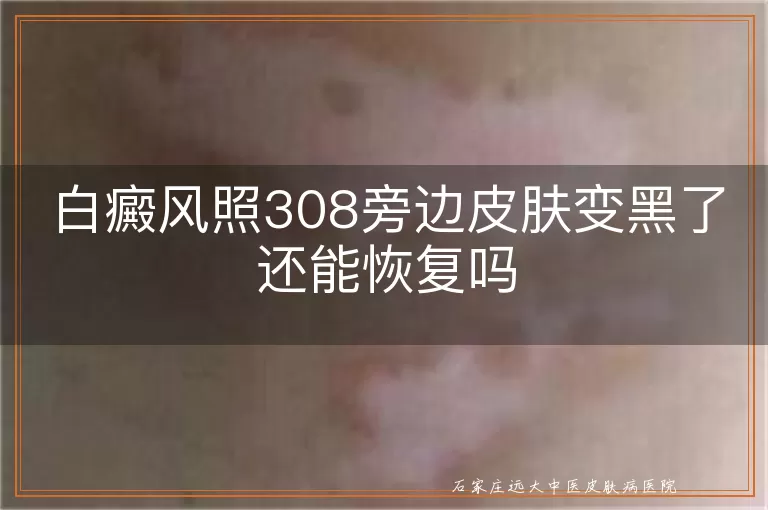白癜风照308旁边皮肤变黑了还能恢复吗