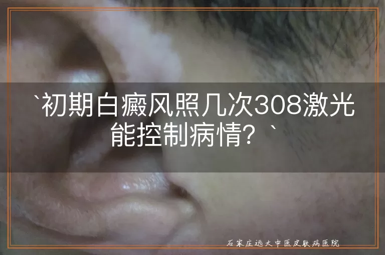 初期白癜风照几次308激光能控制病情？