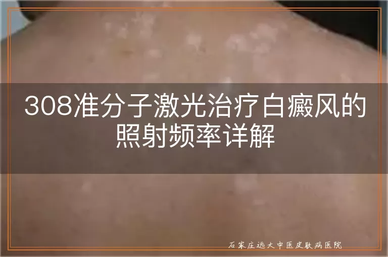 308准分子激光治疗白癜风的照射频率详解