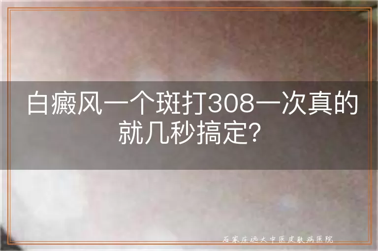 白癜风一个斑打308一次真的就几秒搞定？