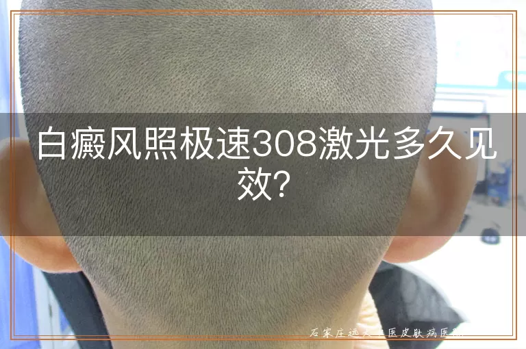 白癜风照极速308激光多久见效？