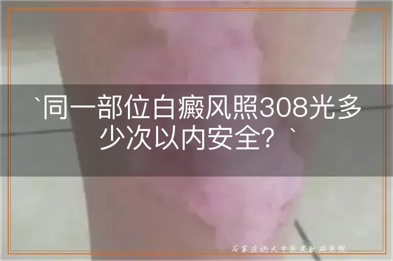 同一部位白癜风照308光多少次以内安全？