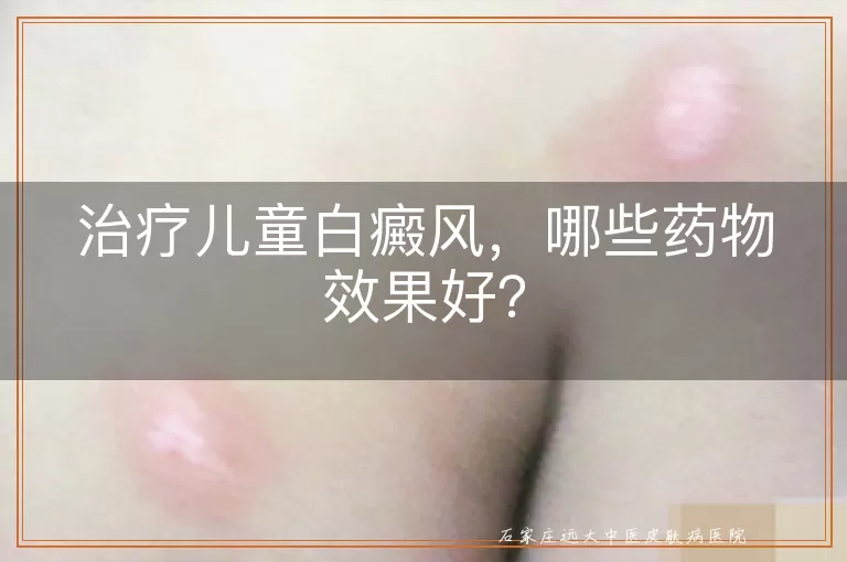 治疗儿童白癜风，哪些药物效果好？