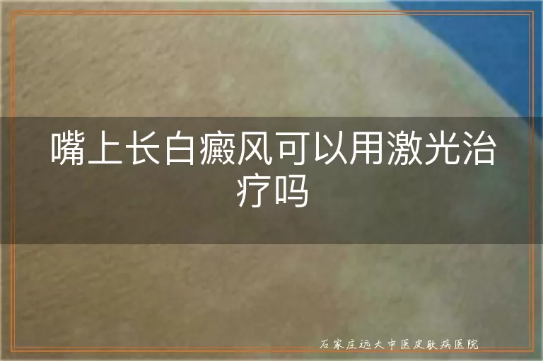 嘴上长白癜风可以用激光治疗吗