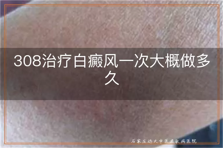 308治疗白癜风一次大概做多久