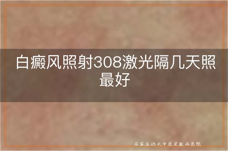 白癜风照射308激光隔几天照最好