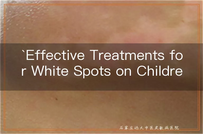Effective Treatments for White Spots on Children's Faces