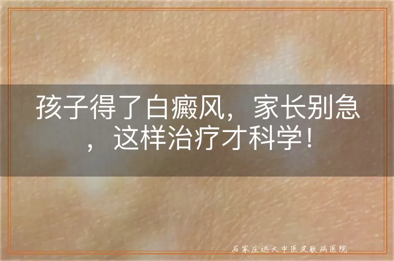 孩子得了白癜风，家长别急，这样治疗才科学！