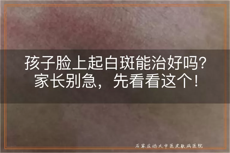 孩子脸上起白斑能治好吗？家长别急，先看看这个！