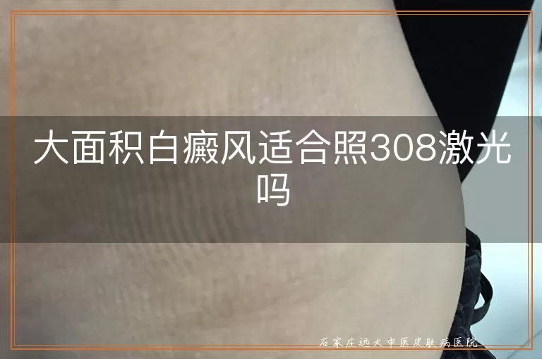 大面积白癜风适合照308激光吗