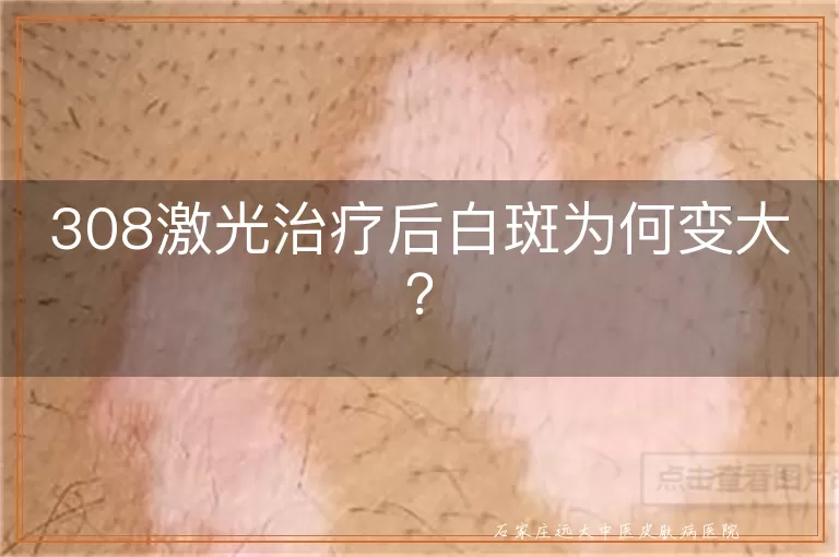 308激光治疗后白斑为何变大？