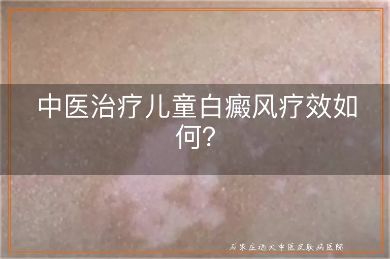中医治疗儿童白癜风疗效如何？