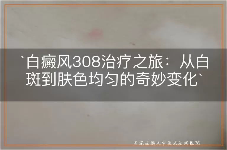 白癜风308治疗之旅：从白斑到肤色均匀的奇妙变化