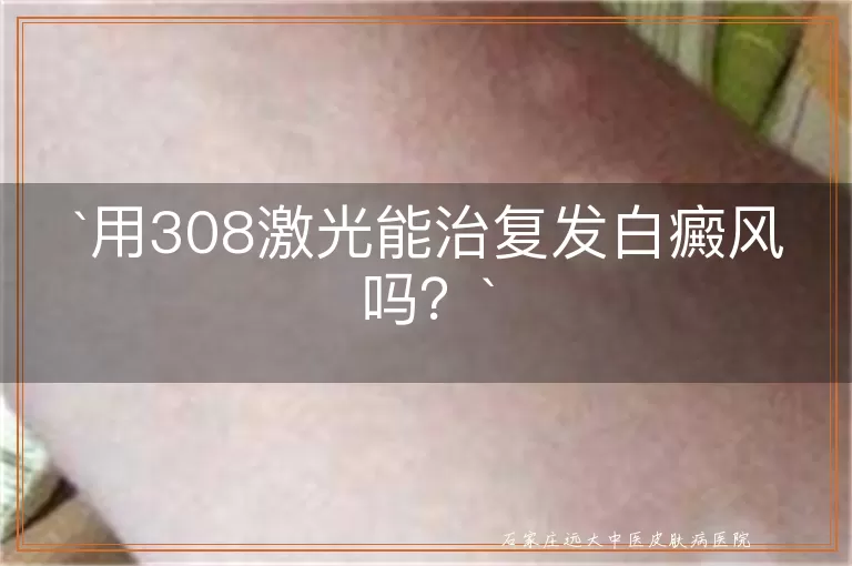 用308激光能治复发白癜风吗？
