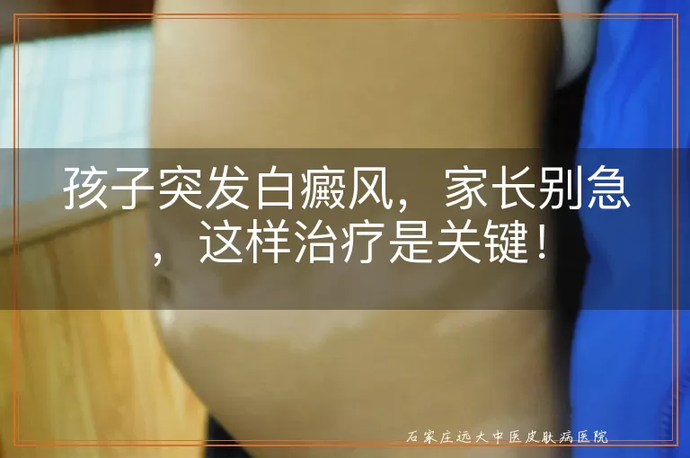 孩子突发白癜风，家长别急，这样治疗是关键！