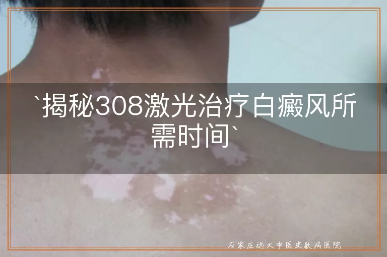 揭秘308激光治疗白癜风所需时间